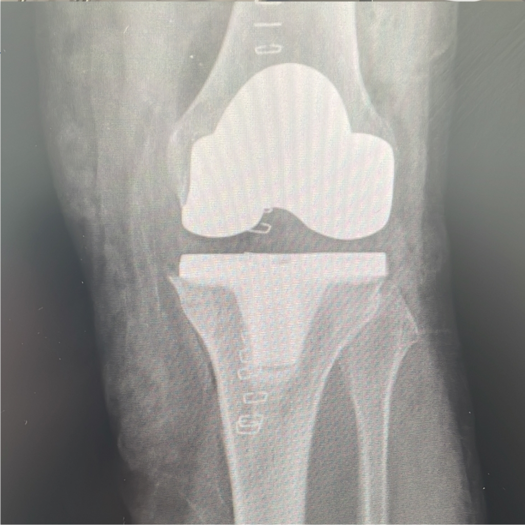 Gonartrosi – Intervento di protesi di ginocchio