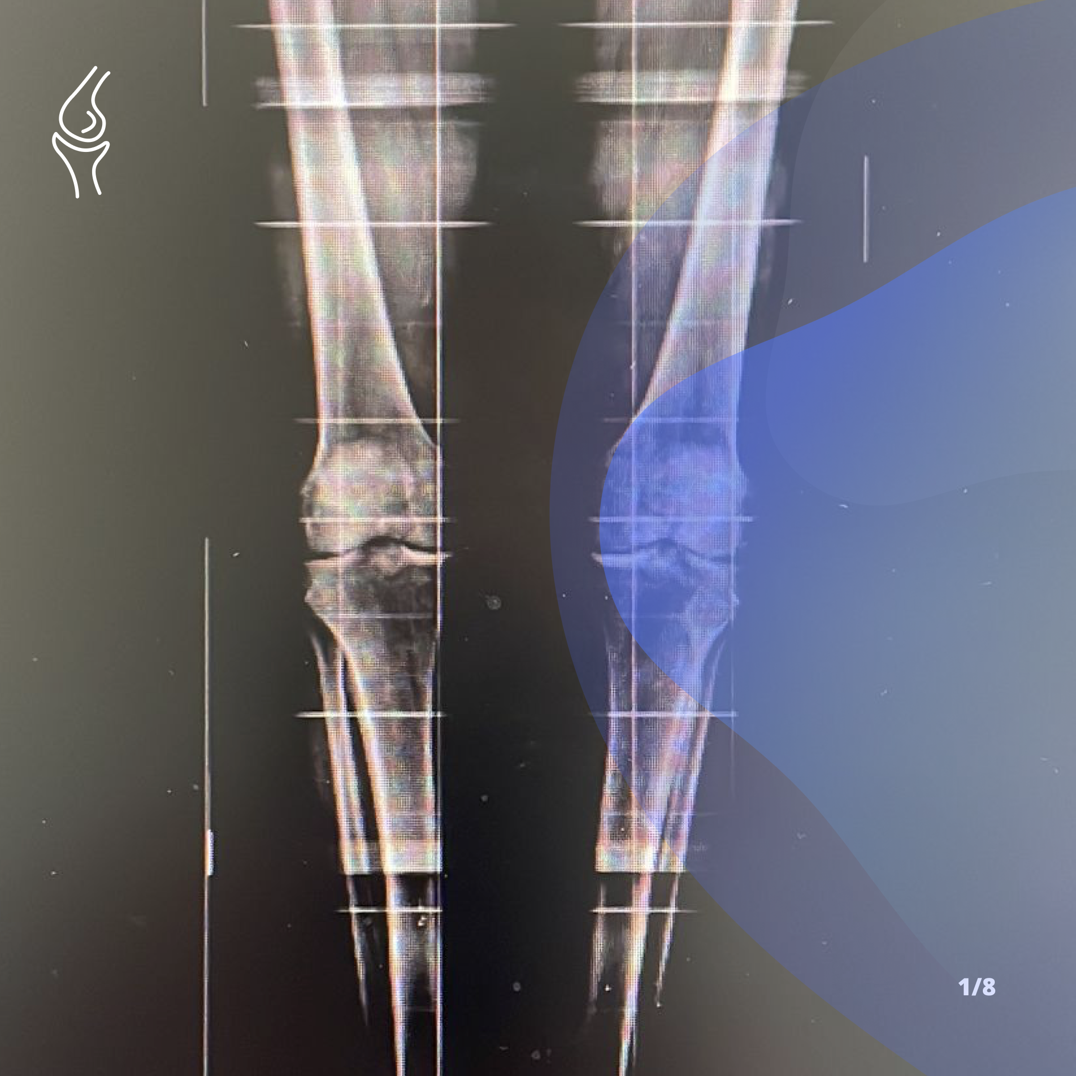 Robotica protesi ginocchio